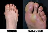I will show you some natural diy remedies that will give you resul. Amazing Ways To Remove Calluses Naturally