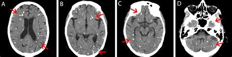 Cureus Central Nervous System Miliary Brain Metastasis Secondary To