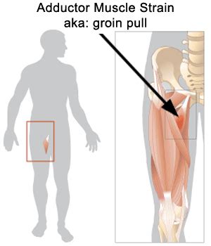 The groin muscles are a group of muscles situated high on the leg in the inner thigh. Athletes: Groin Pull