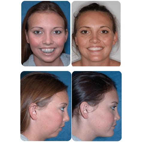 Before and After Photos Maxillofacial Surgery - Larry M ...