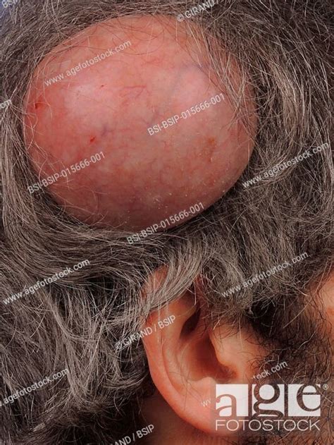 Scalp Trichilemmal Cyst Stock Photo Picture And Rights Managed Image