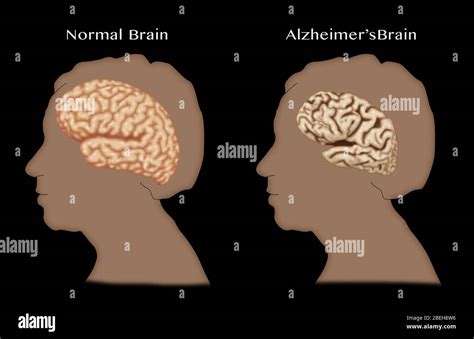 Alzheimer Brain With Normal Brain Hi Res Stock Photography And Images