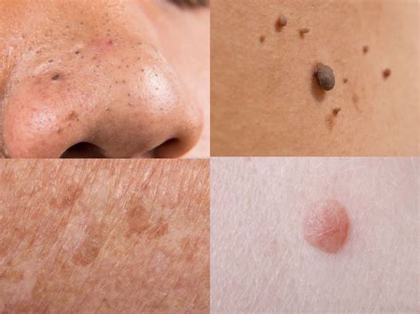 do this to naturally cure age spots moles skin tags warts and blackheads