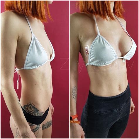Mammoplasty Before And After Implants Cc Implants Breast
