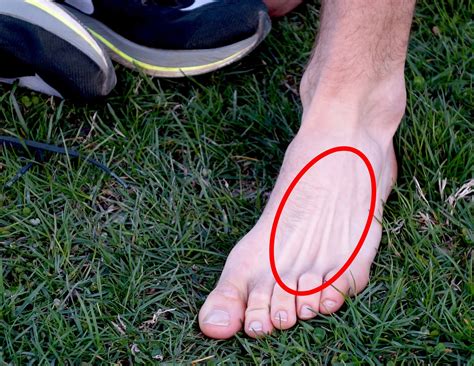 What Causes Metatarsal Stress Fracture In Runners And How Can You