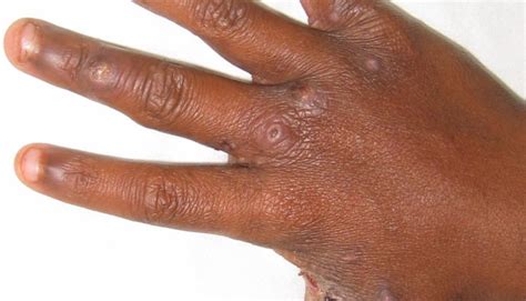 Treatment For Scabies Outbreak Begins In North East Region The Ghana
