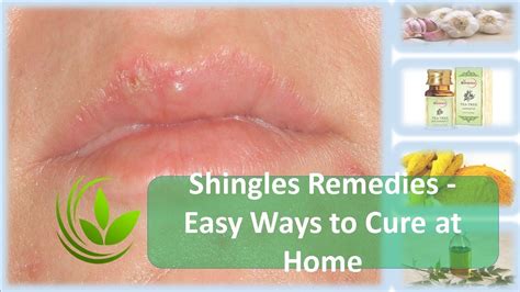 Shingles Remedies Easy Ways To Cure At Home Youtube