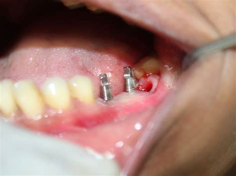 Lower Molar Replacement After Extraction Options