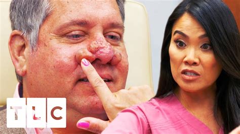 Treating A Severe Case Of Rhinophyma Dr Pimple Popper Youtube