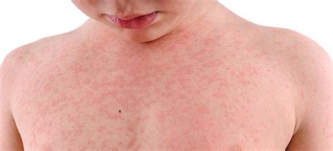 Common Childhood Skin Rashes With Pictures What Rash Is This Which