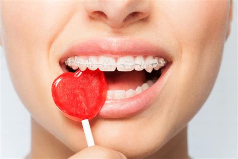 what candy can you eat with dental braces dentists in tx