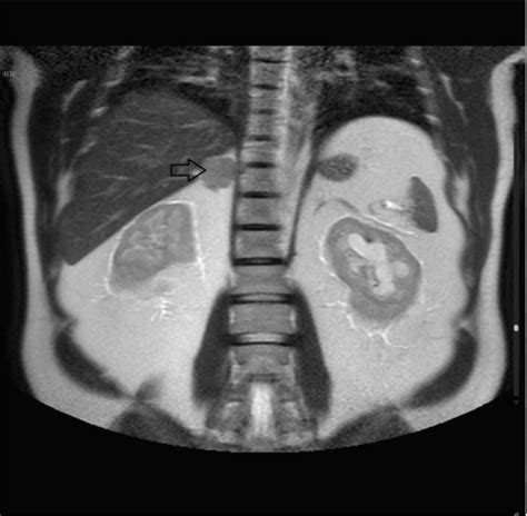 Figure 3 From A Case Report Of Cortisol Secreating Adrenal Adenoma