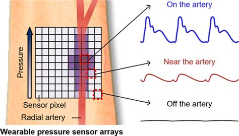 Spatiotemporal Measurement Of Arterial Pulse Waves Enabled By Wearable