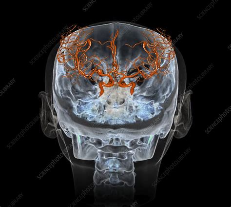 Cerebral Aneurysm 3d Ct Angiogram Stock Image C0388827 Science