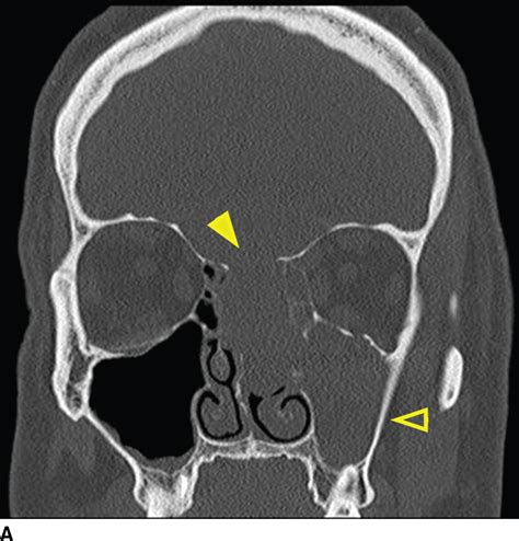 Ventral And Central Skull Base Sinonasal Sellar Parasellar And