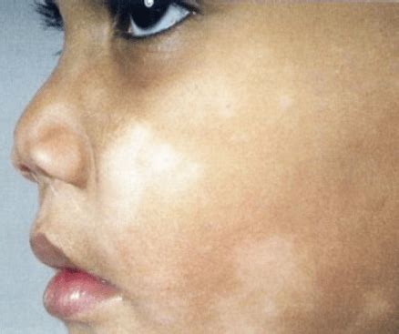 White spots on skin can have many causes. White Spots on Face, Causes, Under Eye, Fungus, Symptoms ...
