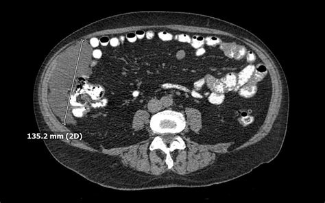 Cureus Benign Multicystic Peritoneal Mesothelioma Presenting As A