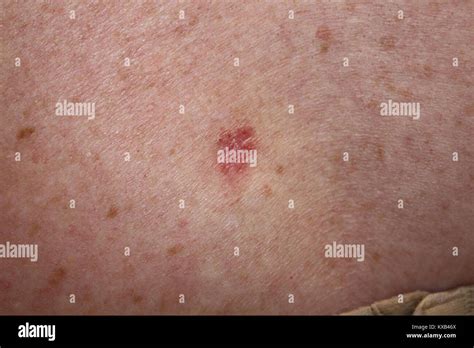 Carcinoma Basocellulare Superficiale Immagini E Fotografie Stock Ad