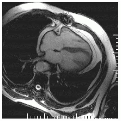 Cardiovascular Magnetic Resonance Imaging Positioning Radiology Key