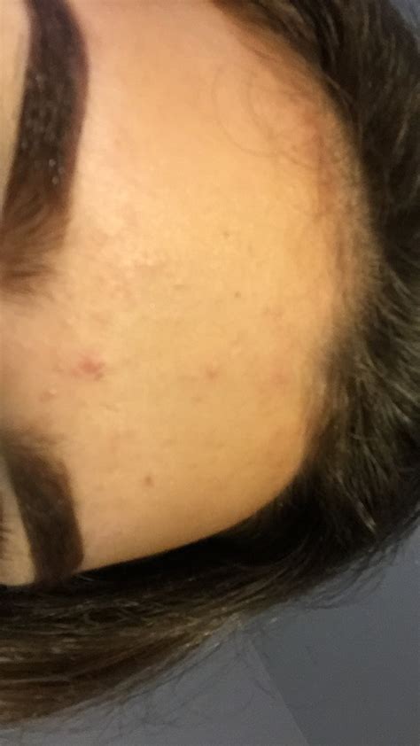 Bumps On My Forehead General Acne Discussion Forum