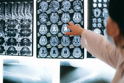 Scientists Find The Root Cause Of A Deadly Brain Cancer