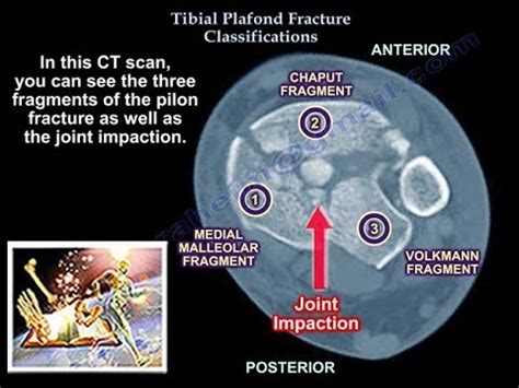 Pilon Fracture Classification