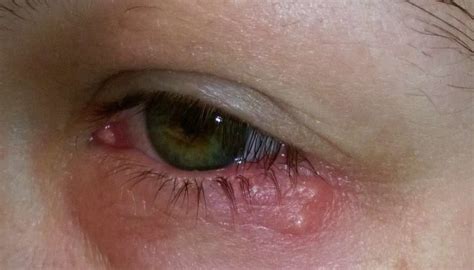 Eye Herpes Pictures Symptoms And Types