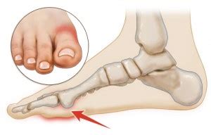 They usually occur after an acute injury although repetitive forced upward movement of the great toe may also lead to an injury of the tissue. Turf Toe — Symptoms, Causes, and Treatment Tips