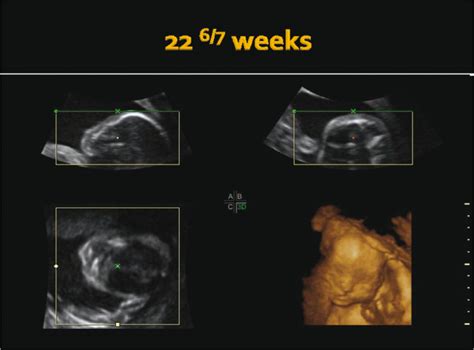 Cleft Lip And Palate 3d Ultrasound