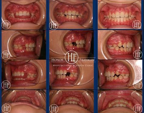27 best images about tongue thrust correction on pinterest disorders the swallows and teeth