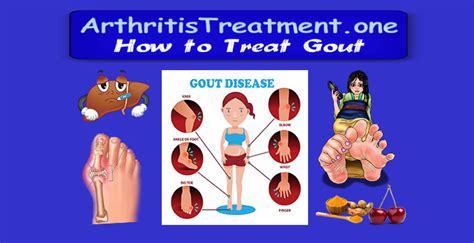 Natural Treatment For Gout Arthritis Treatment