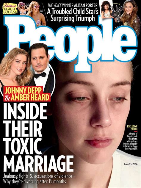 Amber Heard And Johnny Depp Photos Show Alleged Domestic Abuse