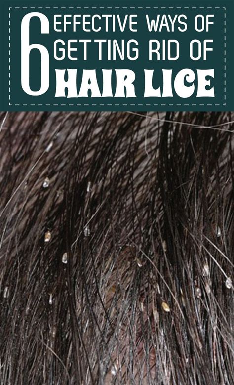 6 Effective Ways Of Getting Rid Of Hair Lice Remedies Corner Home
