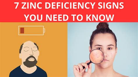 7 Signs Of Zinc Deficiency Hidden Danger Youtube