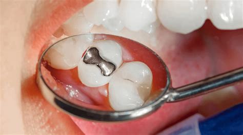 La Aleación De Amalgama Dental En La Actualidad Actualiza Tus