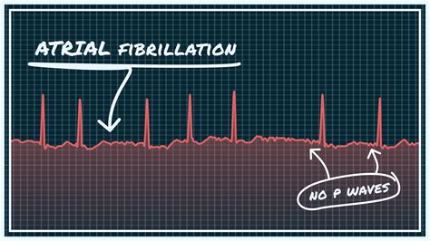 What Atrial Fibrillation Afib Looks Like On Your Watch Ecg Qaly