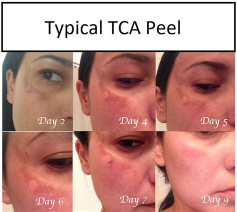 Glycolic Peels And Your Face In 2020 Chemical Peel Peeling Skin