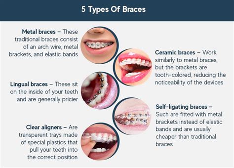 How Do Braces Work Types Materials And Time To Start Working