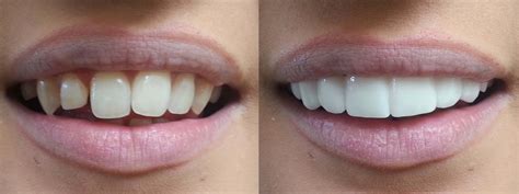Veneers Whats In A Beautiful Smile Hutto Hippo