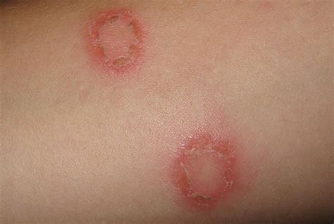 Does Psoriasis Look Like Ringworm