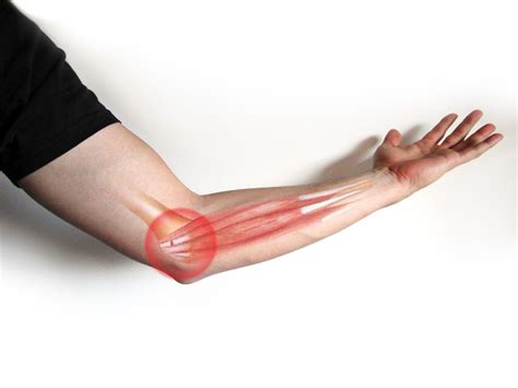 Exercises For The Golfer Elbow Causes Symptoms And Types
