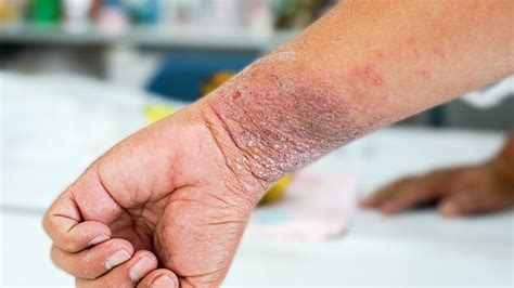 Eczema Symptoms And Diagnosis Everyday Health