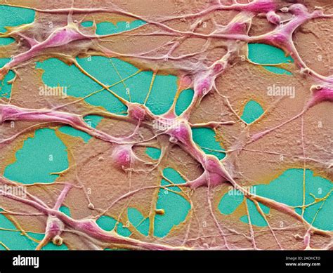 Teratoma Cancer Cells Coloured Scanning Electron Micrograph Sem Of