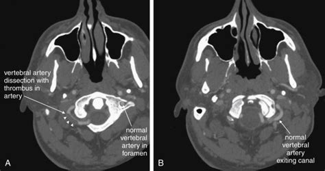 Imaging Soft Tissues Of The Neck Radiology Key