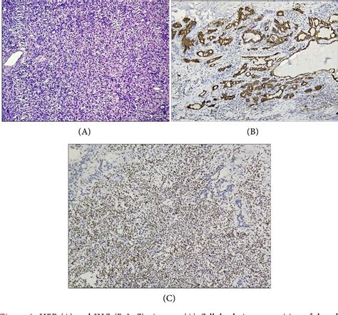 Figure 3 From Benign Salivary Gland Tumour Presenting As Unilateral
