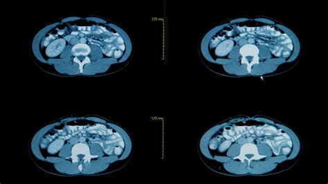 Ct Scan With Contrast Health Hearty