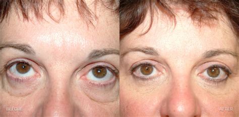 Pinch Blepharoplasty 11 Lorne K Rosenfield