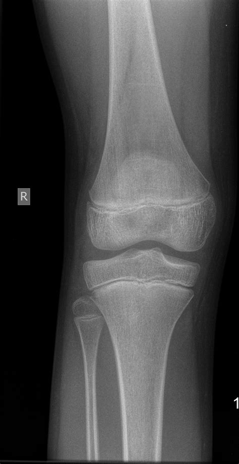 A Frontal Knee X Ray Showing Osteolysis At The Kneecap And A Mobile