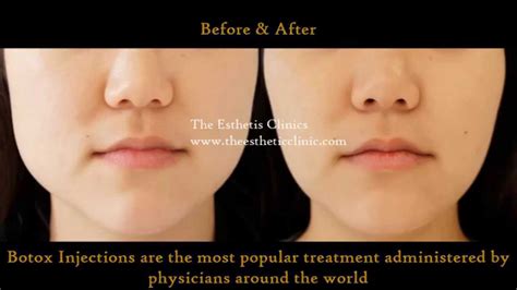 Botox Injection Treatment For Masseter Hypertrophy Jawline Reduction