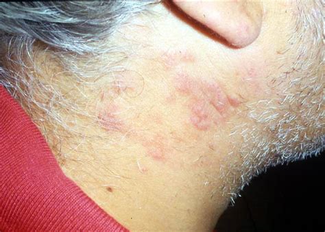 Superficial Fungal Infections Tinea Picture Hellenic Dermatological